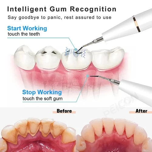 Ultrasonic Tooth Cleaner - Cleans teeth