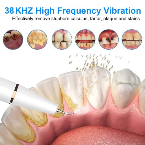 Ultrasonic Tooth Cleaner - Cleans teeth